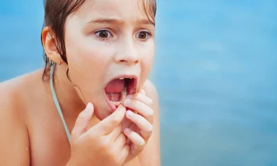 golpes en dientes de leche